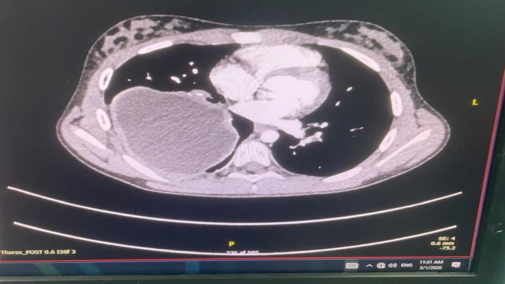 نجاح عملية قلب معقدة في مركز الملكة علياء