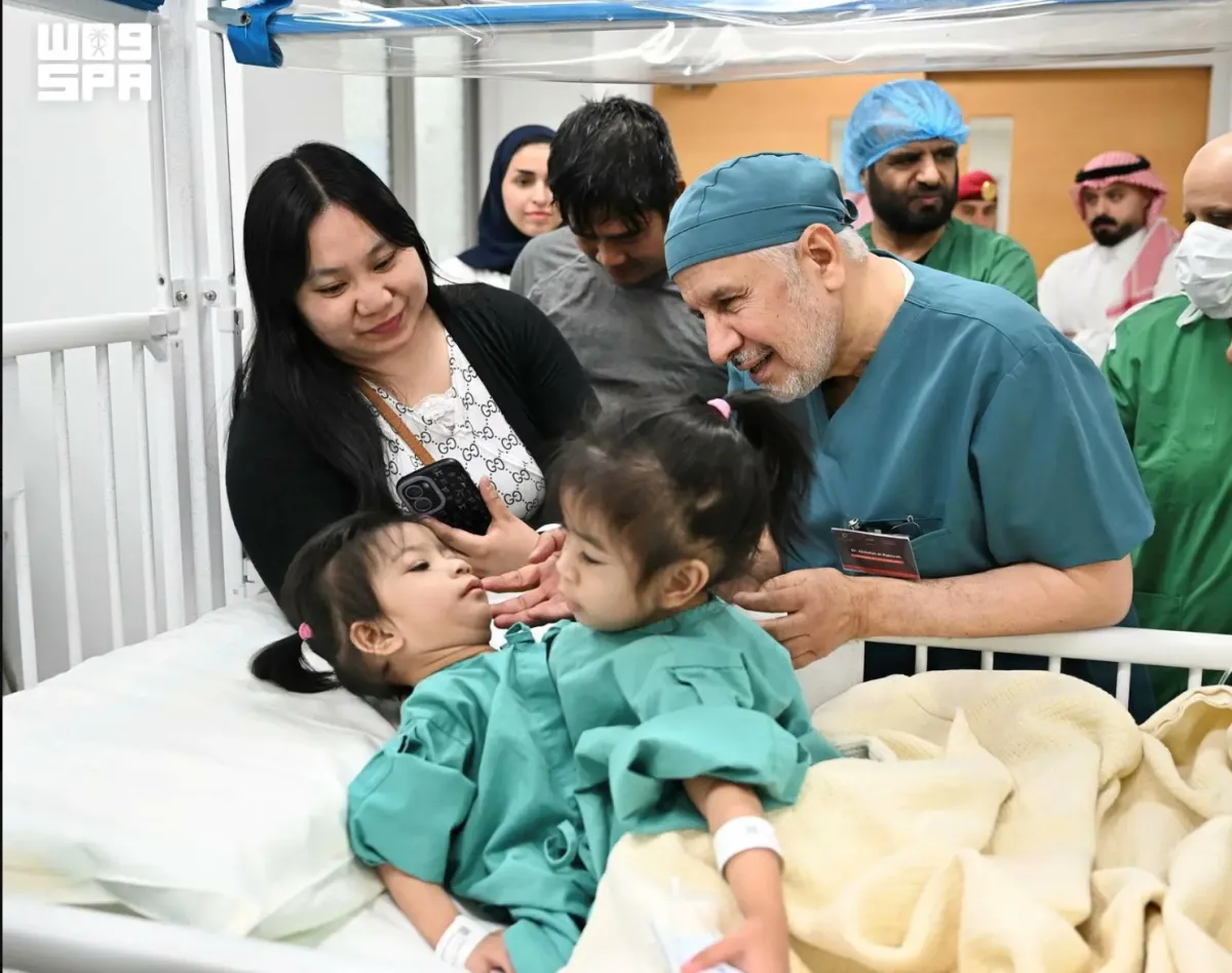 بدء عملية فصل التوام الفلبيني اوليفيا وجيانا في الرياض