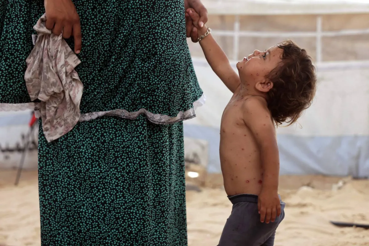 تفاقم الازمات الصحية في غزة مع انتشار واسع لمرض جدري الماء
